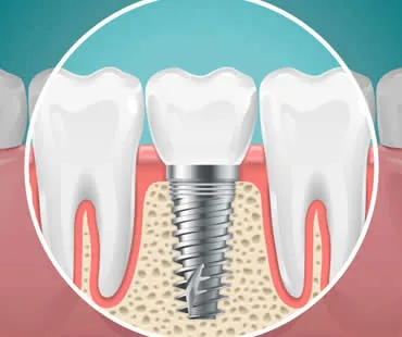 dentalimplants
