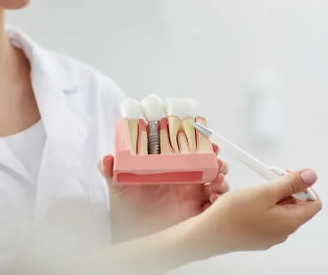 dentalimplants