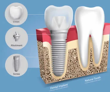 dentalimplants