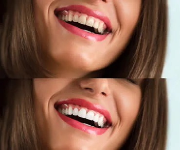 whitening