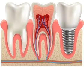 dental implant