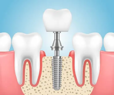 Private: Dental Implants: The Most Advanced Choice for Tooth Restoration
